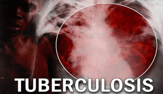 En 2013 se registraron 8.327 casos de tuberculosis