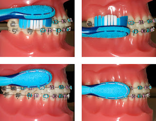 Can I Use an Electric Toothbrush with Braces?, How to Brush Teeth with Braces?, Braces pain