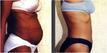 abdominoplasty before and after