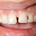 Trồng răng sứ có bền không? Phụ thuộc vào điều gì?