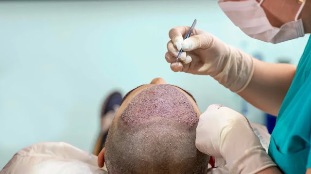 Enriched FUE Hair Transplant Technique in Delhi