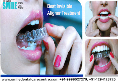 Best Invisible Aligner Treatment in Faridabad