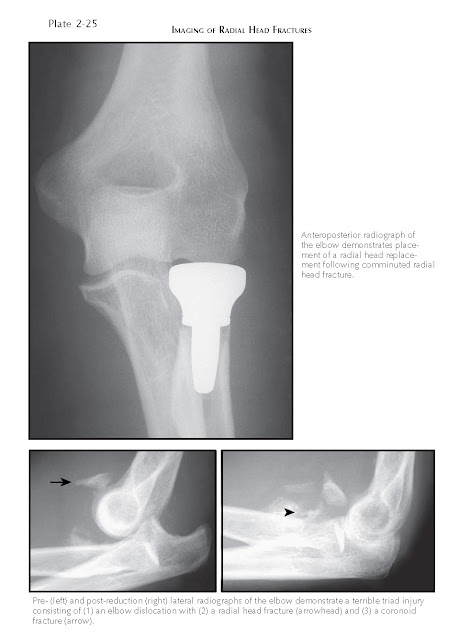 IMAGING OF RADIAL HEAD FRACTURES