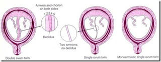 Selaput ketuban pada kehamilan kembar 