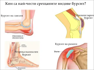 ДМСО при Бурсит