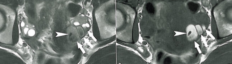 Chapitre 3 : Endometriose pelvienne