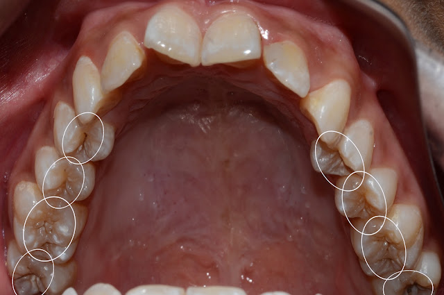 Dental Decay in multiple Teeth in Upper Arch