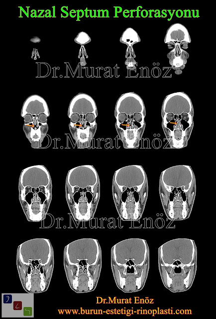 Septum perforasyonu tanımı - Septum perforasyonu  nedenleri - Septum perforasyonu belirtileri - Septum perforasyonu tedavisi - Açık teknik septum perforasyonu ameliyatı - Açık teknik septum perforasyonu onarımı - Burun duvarında delik