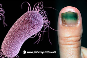 pseudomonas aeruginosa infection