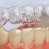 Niềng răng Invisalign có làm thay đổi khuôn mặt không?