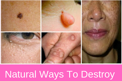 Natural Ways To Destroy Moles, Warts, Blackheads, Skin Tags And Age Spots