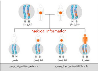 الثلاسيميا أعراض وأسباب وطرق العلاج