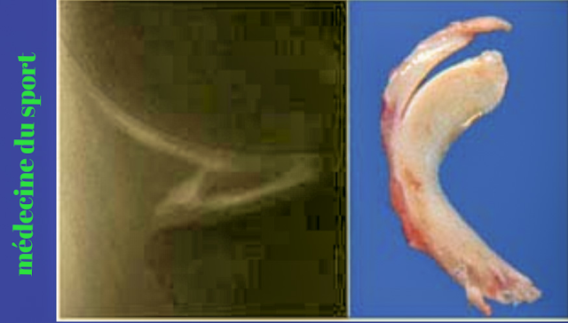 Pathologies des ménisques