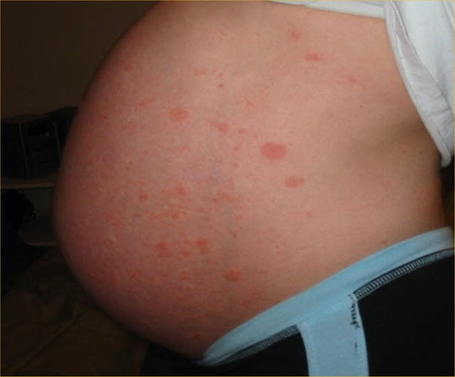 benefits of coffee scrub for stretch marks