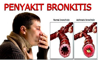 Penyakit Bonhitis