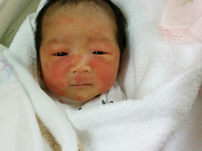コンプリート！ 赤ちゃん 赤い斑点 129438-赤ちゃん 赤い斑点 首