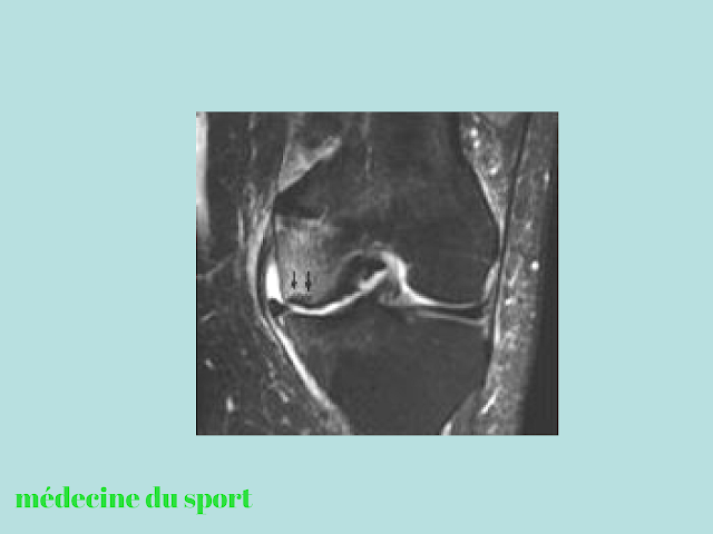 IMAGERIE DU GENOU APPLIQUÉE A LA PATHOLOGIE SPORTIVE