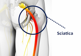 sciatica pain illustration