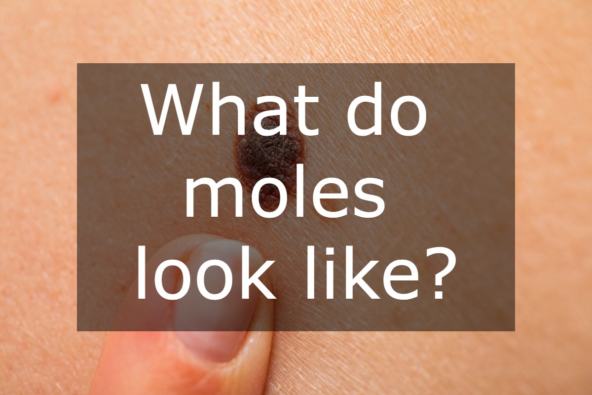 Do You Need to Worry About a Mole?