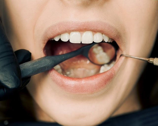 Mexico Dentist - 3Advantages and 3 Disadvantages