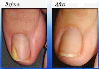 Understanding the Early Stages of Toenail Fungus