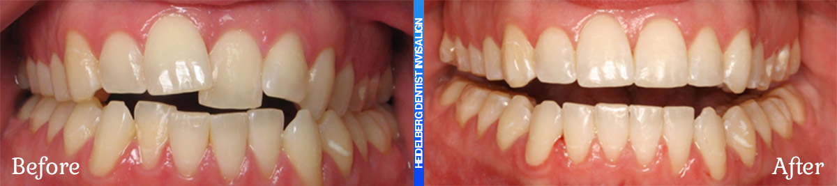 Invisalign Melbourne Before & After Smile Gallery