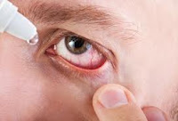 Inflammatory diseases of the eye