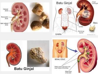 Cara Tradisional mengobati batu ginjal selain operasi yang ampuh dan efektif