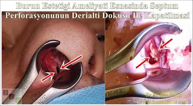 Deri altı dokusu ile septum perforasyonu tamiri - Deri altı dokusu ile septum perforasyonu ameliyatı - Septum perforasyonu tedavisi - Nazal septum perforasyonu operasyonu - Açık teknik septum perforasyonu ameliyatı - Açık teknik septum perforasyonu onarımı - Burun estetiği ile birlikte septum perforasyonu kapatılması - Burun septumunda delik kapatılması - Burun septum perforasyonu ameliyatı - Septum perforation closure in Istanbul - Septum perforation closure with under skin tissue - Closure of nasal septal perforations using under skin tissue - Combining rhinoplasty with septal perforation repair