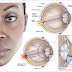 Glaucoma ( Symptons and Treatment)