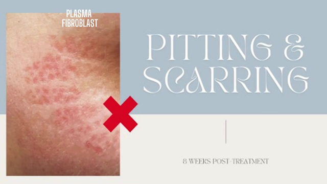 plasma fibroblast pitting scarring