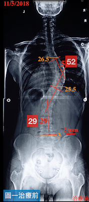 脊椎側彎度數, 脊椎側彎運動, 脊椎側彎治療, 脊椎側彎矯正