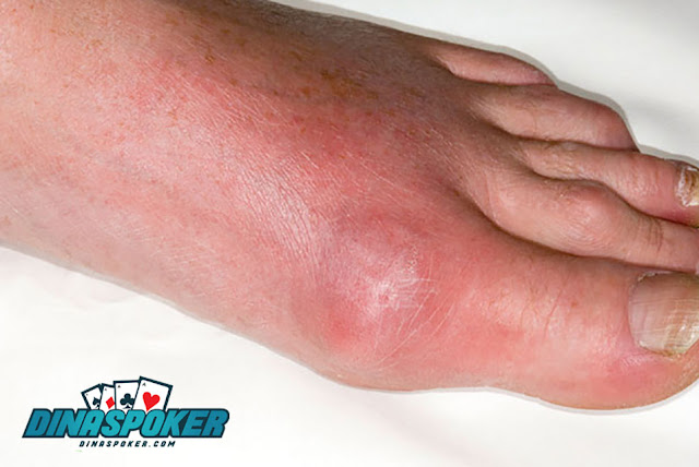 The Ultimate Cure Gout Naturally in Home Trick