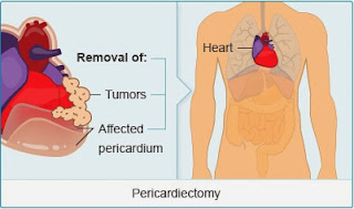 Pericardial Mesothelioma