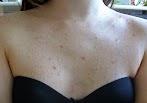 Pickelmale Rücken / Pickelmale Po - Wie bekämpfe ich schnell und effektiv ... / Hausmittel gegen pickelmale entfernen pickelnarben durch bleichen der haut im gesicht.