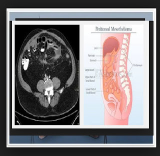 The Facts Virtually Peritoneal Mesothelioma