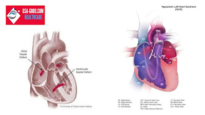 What is Congenital Heart Disease In Adults?