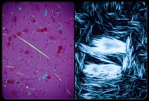 amorphous urate crystals in urine. amorphous phosphates in urine.