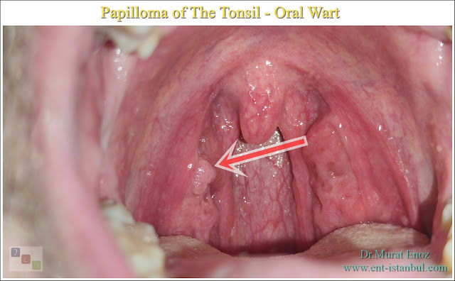Papilloma of The Tonsil - Oral Wart - HPV infection