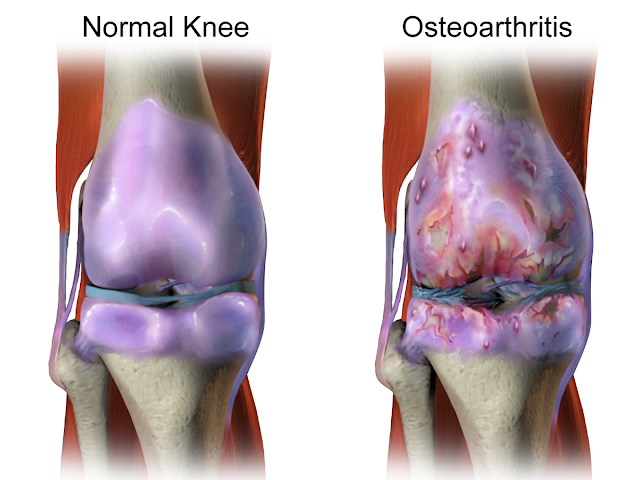Microphone: A new modality for diagnosing knee osteoarthritis