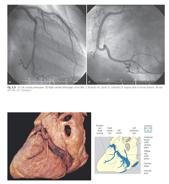 Oblique view of the coronary sinus lying in the coronary sulcus.