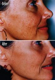 chemical peel before and after drawing