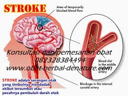 obat stroke herbal,obat herbal stroke,obat stroke denature,obat lumpuh separo,obat stroke ringan,obat stroke berat