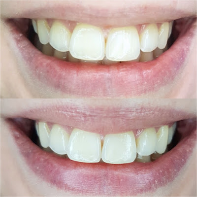 Misfit Cosmetics Activated Charcoal Teeth Whitening Powder before and after