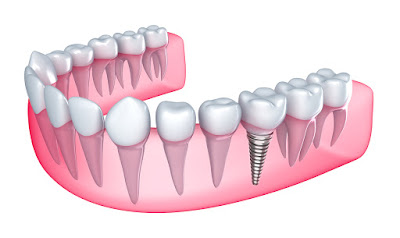 Trồng răng hàm có đau không?