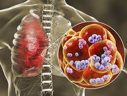 A Comprehensive Guide to Pneumonia: Understanding Symptoms, Diagnosis, Treatment, and Prevention//pneumonia disease/
