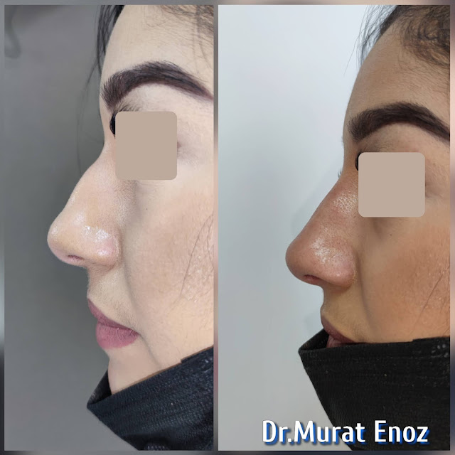 Cost of non-surgical rhinoplasty in Istanbul,Nose filler injection cost in Turkey,Cost of non-surgical nose job in Istanbul,Cost of non surgical nose job with filler in Istanbul,