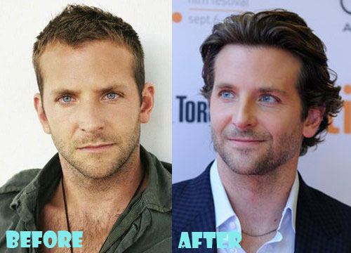 Bradley Cooper Plastic Surgery Before And After