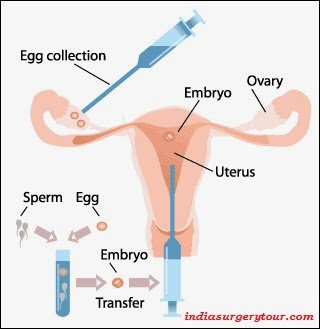 Infertility Surgery India 