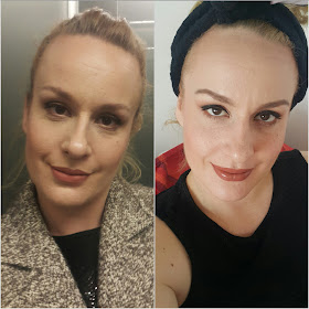 Lice prije i nakon 2 mjeseca korištenja Olival peptidnog seruma